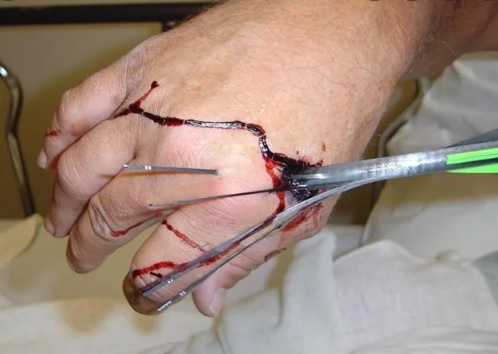 archery injuries